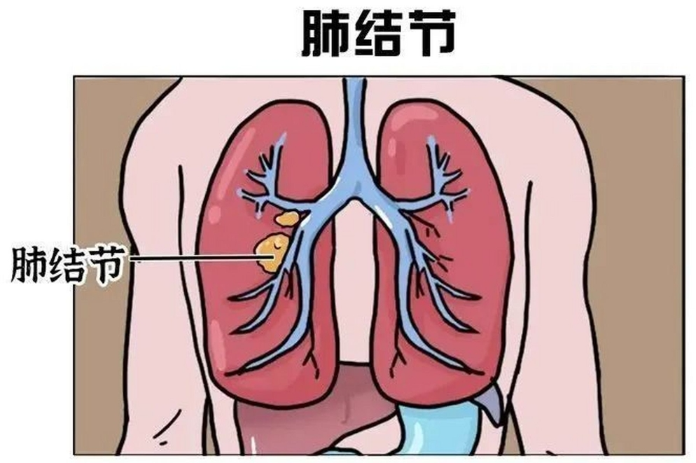 专业宝典！肺结节位置性质精准识别，为健康保驾护航