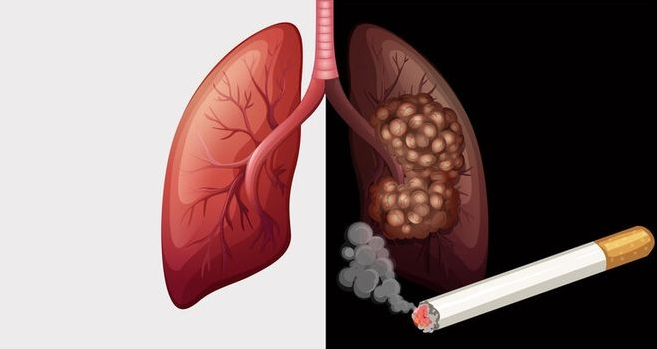 烟雾下的童年悲歌：10 岁孩童竟患肺癌，别让烟草的烟雾，吞噬孩子的美好童年！