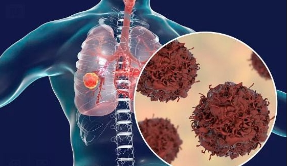 警惕！身体发出的这10个信号，可能是癌症在"敲门"！早发现能救命