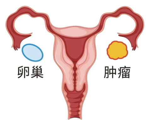浅谈&ldquo;沉默的杀手&rdquo;&mdash;&mdash;卵巢肿瘤