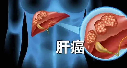 肝癌术后复发率高达70%！读懂复发那些事，才能稳稳护好肝