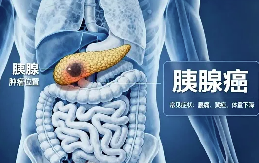 拉肚子别只当肠胃病！小心&ldquo;癌王&rdquo;胰腺癌，这些信号别错过
