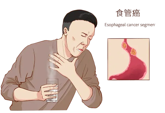 吃饭总噎着？小心食管在&ldquo;喊救命&rdquo;