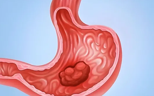 身体出现这些信号很可能是胃癌