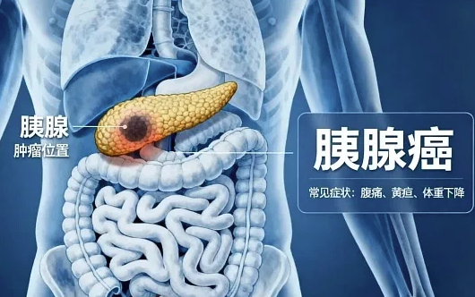 别把胰腺癌当胃病！饭后这几个信号，是身体在喊救命