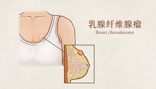 乳腺纤维腺瘤：年轻女性最常见的良性肿瘤，切还是不切？