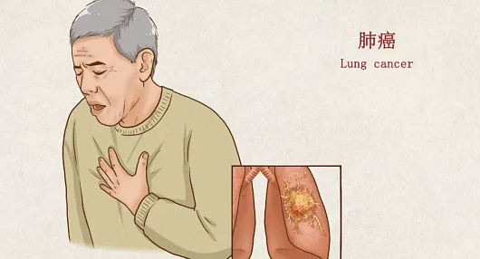小细胞肺癌，肺腺癌，肺鳞癌区别在哪里？最危险的是哪个？