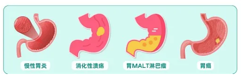 不用开刀化疗？这种癌吃普通消炎药竟能九成治好