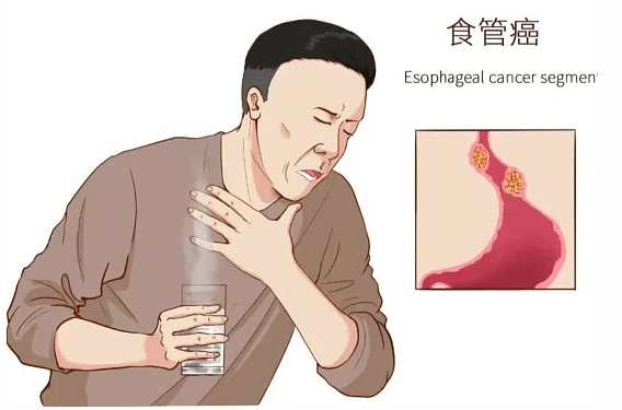 食管癌：全球一半在中国，这些信号别再当成咽炎！