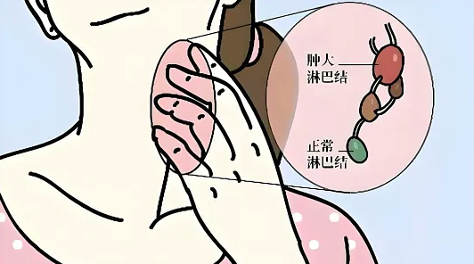 淋巴结肿大都是淋巴瘤吗？该怎么自己简单鉴别？
