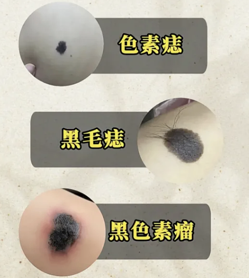 不是所有黑痣都安全！这种&ldquo;普通小黑痣&rdquo;，竟是皮肤癌前兆