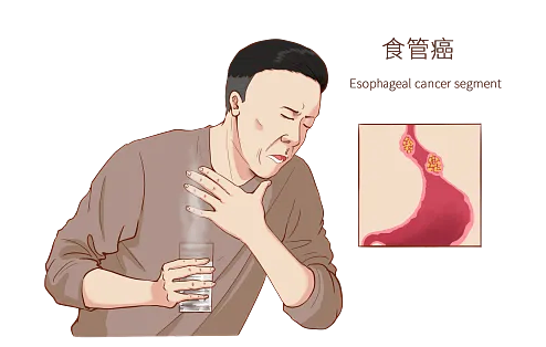 总把吞咽不适当咽炎？小心是食管在求救