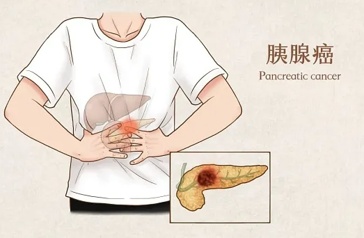 识别胰腺癌早期信号,牢记"胀痛黄瘦乱"5字诀