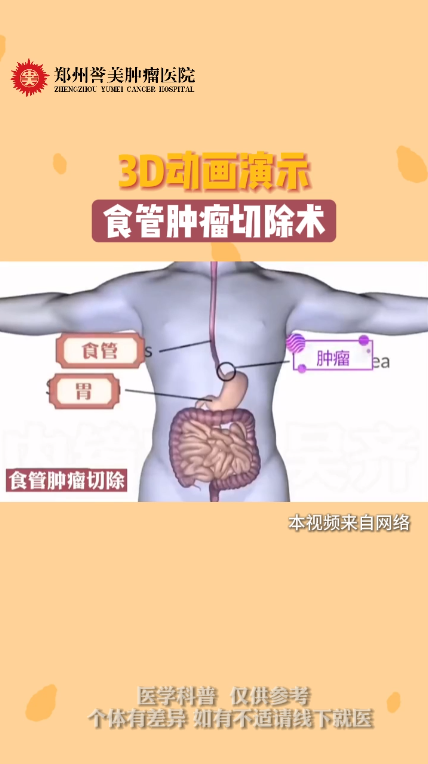 第三十八期 3D动画演示食管癌切除手术