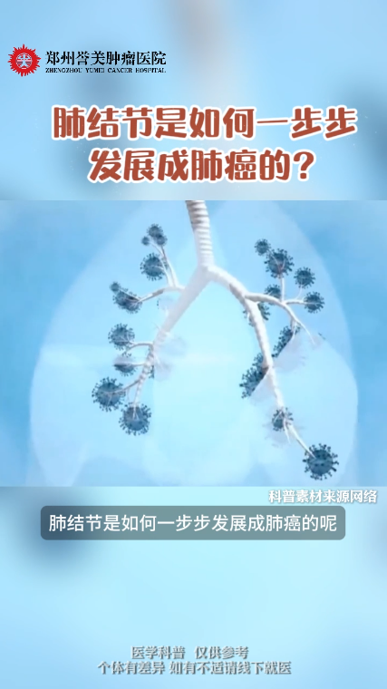 第四十二期 肺结节是如何一步步发展成肺癌的