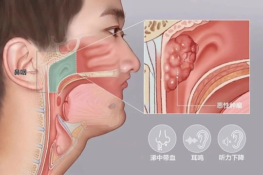 鼻涕带血别当上火！这个 &ldquo;中国癌&rdquo; 专坑爱吃咸鱼的人