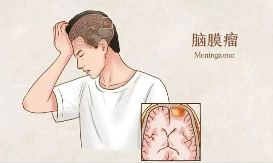 查出脑膜瘤，天塌了吗？先别慌，这份&ldquo;应对指南&rdquo;请收好