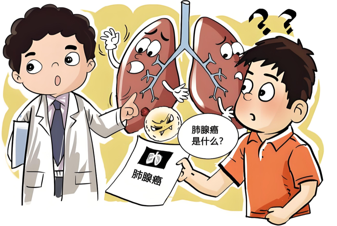肺腺癌为什么是幸运癌？