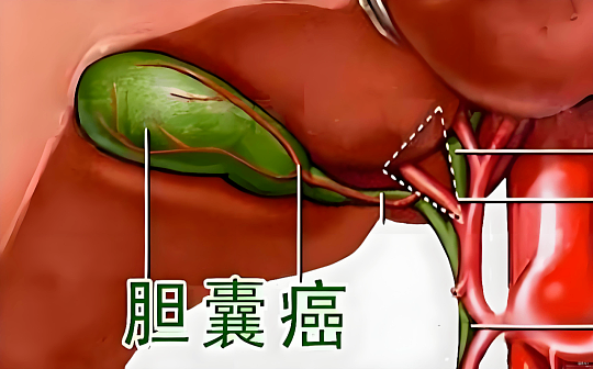 一颗小石头磨出的 &ldquo;夺命癌&rdquo;：别等胆囊喊疼才重视它