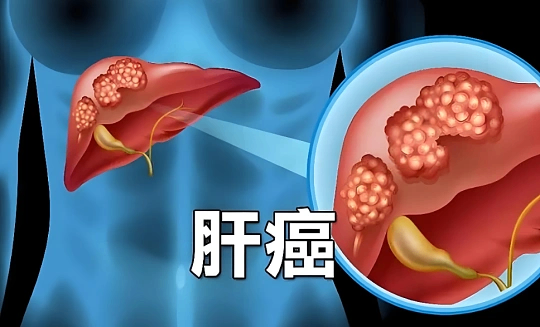 肝癌术后复发率竟高达70%？关于肝癌的这些&ldquo;硬核&rdquo;干货，不容错过！