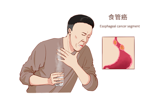 别让&ldquo;咽不下&rdquo;拖成大病！战胜食管癌，从了解开始！