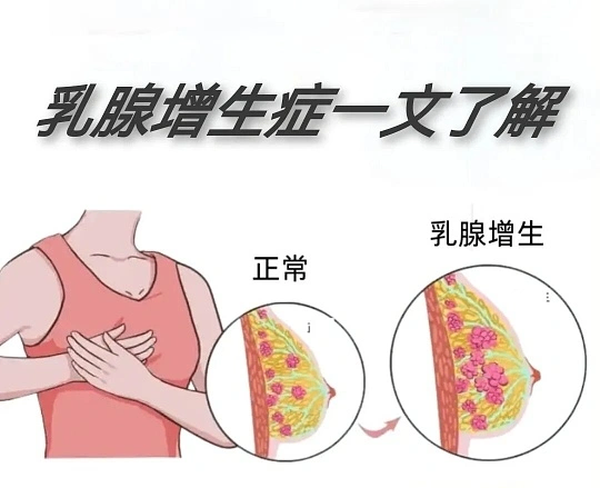 乳腺增生不用慌！90%的女性都会遇到，这样应对就对了