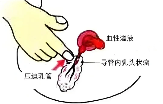 内衣上出现神秘血迹？警惕乳腺里的&ldquo;隐形小瘤子&rdquo;