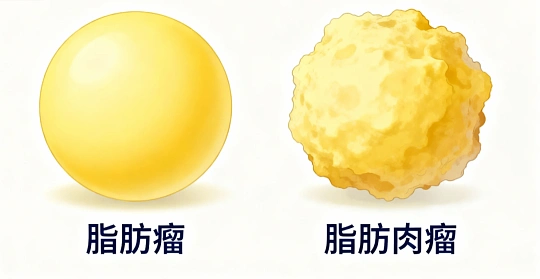 身上摸出个"肉疙瘩"，别都当脂肪瘤！这种"一字之差"的病可能是恶性的